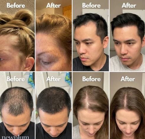 Buy Newplum Advanced Hair Growth Roll-On Serum Online